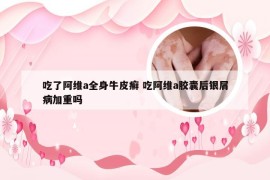 吃了阿维a全身牛皮癣 吃阿维a胶囊后银屑病加重吗