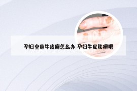 孕妇全身牛皮癣怎么办 孕妇牛皮肤癣吧