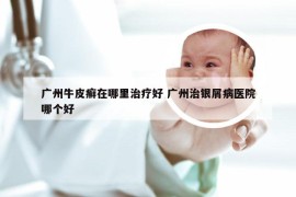 广州牛皮癣在哪里治疗好 广州治银屑病医院哪个好