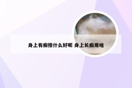 身上有癣擦什么好呢 身上长癣用啥