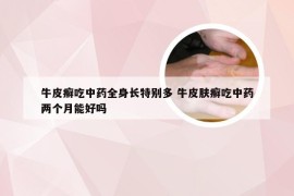 牛皮癣吃中药全身长特别多 牛皮肤癣吃中药两个月能好吗