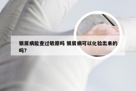 银屑病能查过敏原吗 银屑病可以化验出来的吗?