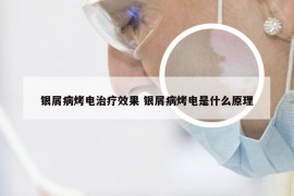 银屑病烤电治疗效果 银屑病烤电是什么原理