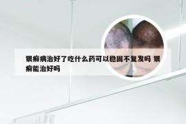 银癣病治好了吃什么药可以稳固不复发吗 银癣能治好吗