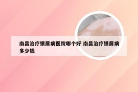 南昌治疗银屑病医院哪个好 南昌治疗银屑病多少钱