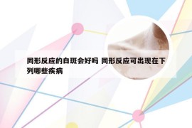 同形反应的白斑会好吗 同形反应可出现在下列哪些疾病