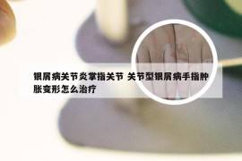 银屑病关节炎掌指关节 关节型银屑病手指肿胀变形怎么治疗