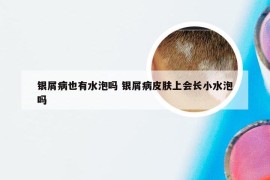 银屑病也有水泡吗 银屑病皮肤上会长小水泡吗