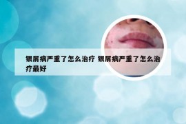 银屑病严重了怎么治疗 银屑病严重了怎么治疗最好