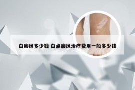 白癜风多少钱 白点癫风治疗费用一般多少钱