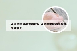 点滴型银屑病发病过程 点滴型银屑病爆发期持续多久