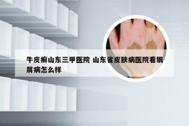 牛皮癣山东三甲医院 山东省皮肤病医院看银屑病怎么样