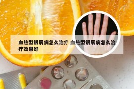 血热型银屑病怎么治疗 血热型银屑病怎么治疗效果好