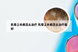 乳晕上长癣怎么治疗 乳晕上长癣怎么治疗最好