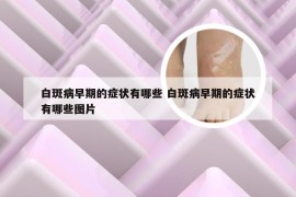 白斑病早期的症状有哪些 白斑病早期的症状有哪些图片