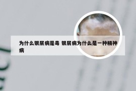 为什么银屑病是毒 银屑病为什么是一种精神病