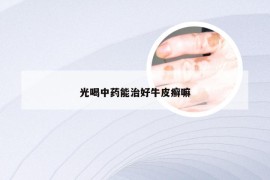 光喝中药能治好牛皮癣嘛