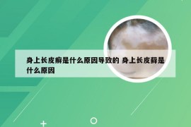 身上长皮癣是什么原因导致的 身上长皮藓是什么原因