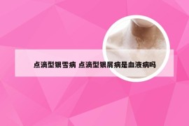 点滴型银雪病 点滴型银屑病是血液病吗