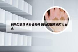 斑块型银屑病能长寿吗 斑块型银屑病可以自愈