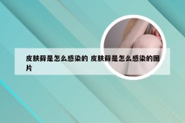 皮肤藓是怎么感染的 皮肤藓是怎么感染的图片