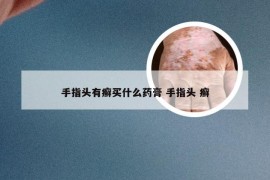 手指头有癣买什么药膏 手指头 癣