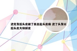 烫完发后头皮破了而且起头皮癣 烫了头发以后头皮大块掉皮