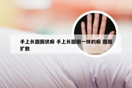 手上长圆圈状癣 手上长圆圈一样的癣 圆圈扩散