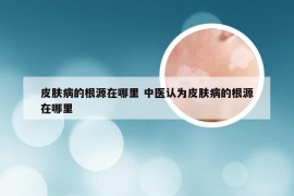 皮肤病的根源在哪里 中医认为皮肤病的根源在哪里