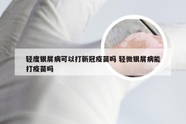 轻度银屑病可以打新冠疫苗吗 轻微银屑病能打疫苗吗