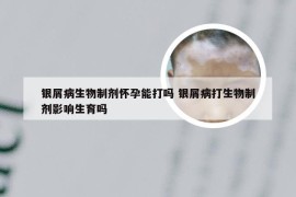 银屑病生物制剂怀孕能打吗 银屑病打生物制剂影响生育吗