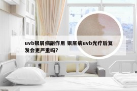 uvb银屑病副作用 银屑病uvb光疗后复发会更严重吗?