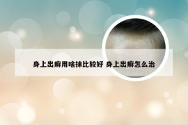 身上出癣用啥抹比较好 身上出癣怎么治