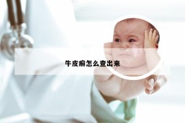 牛皮癣怎么查出来