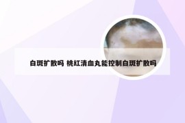 白斑扩散吗 桃红清血丸能控制白斑扩散吗