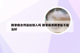 鹅掌癣会传染给别人吗 鹅掌癣用鹅掌能不能治好