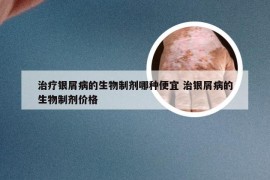 治疗银屑病的生物制剂哪种便宜 治银屑病的生物制剂价格