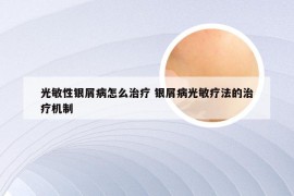 光敏性银屑病怎么治疗 银屑病光敏疗法的治疗机制