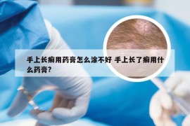 手上长癣用药膏怎么涂不好 手上长了癣用什么药膏?