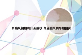 白癜风初期有什么症状 白点癫风的早期图片