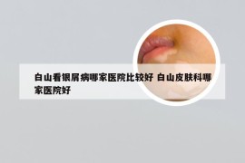 白山看银屑病哪家医院比较好 白山皮肤科哪家医院好