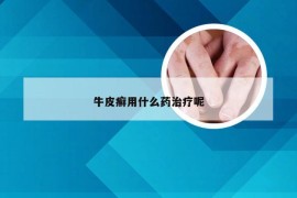 牛皮癣用什么药治疗呢