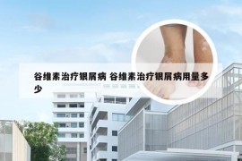 谷维素治疗银屑病 谷维素治疗银屑病用量多少