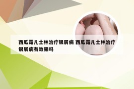 西瓜霜凡士林治疗银屑病 西瓜霜凡士林治疗银屑病有效果吗