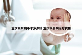 重庆银屑病手术多少钱 重庆银屑病治疗费用