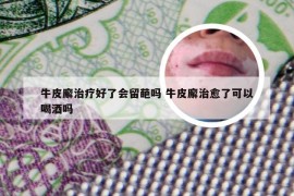 牛皮廨治疗好了会留葩吗 牛皮廨治愈了可以喝酒吗