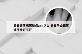 长春银屑病医院点zan华山 长春华山银屑病医院好不好