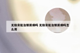 无极膏能治银屑病吗 无极膏能治银屑病吗怎么用