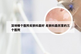 深圳哪个医院皮肤科最好 皮肤科最厉害的三个医院