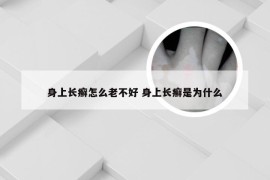 身上长癣怎么老不好 身上长癣是为什么